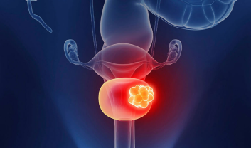 BLADDER CANCER