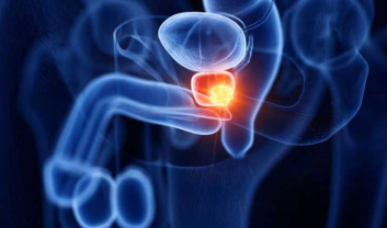 PROSTATE CANCER