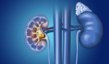 KIDNEY STONE