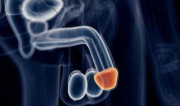 BALANITIS