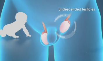 UNDESCENDED TESTIS