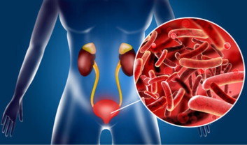 TRACT INFECTION