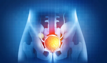 PROSTATE HYPERPLASIA