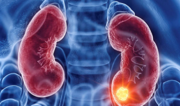 KIDNEY CANCER